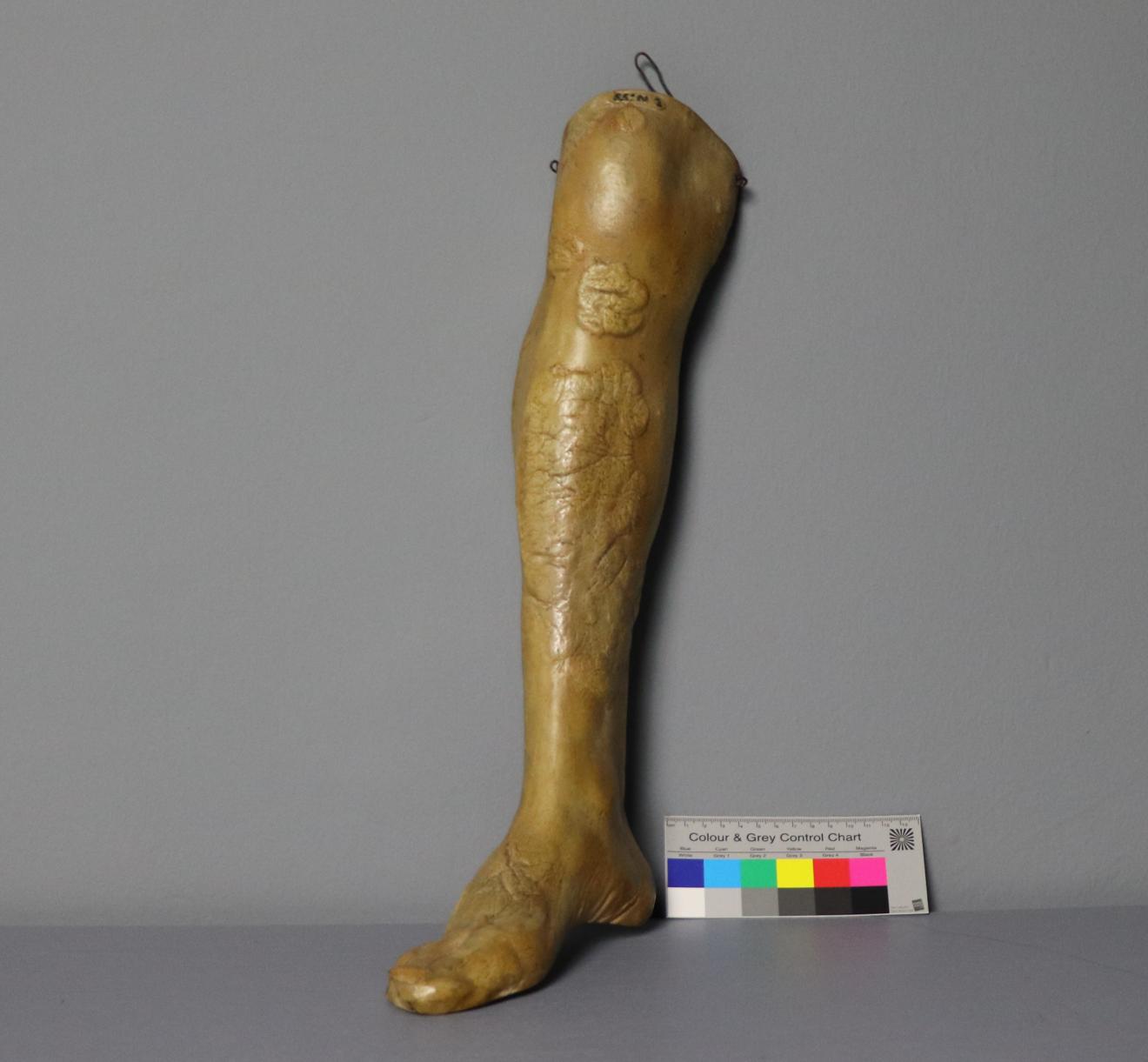 Psoriasis de pierna y pie