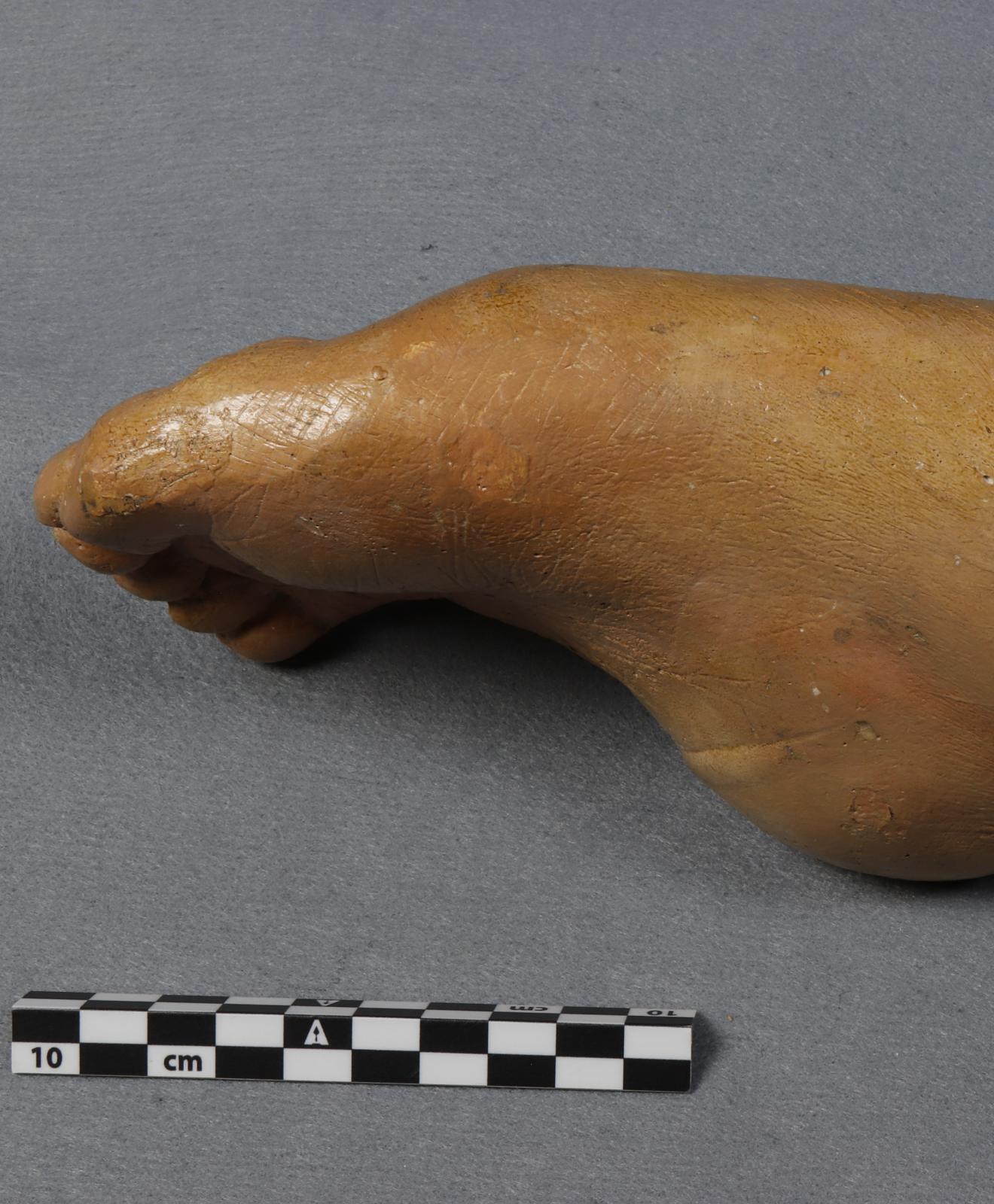 Vicio de conformación del pie