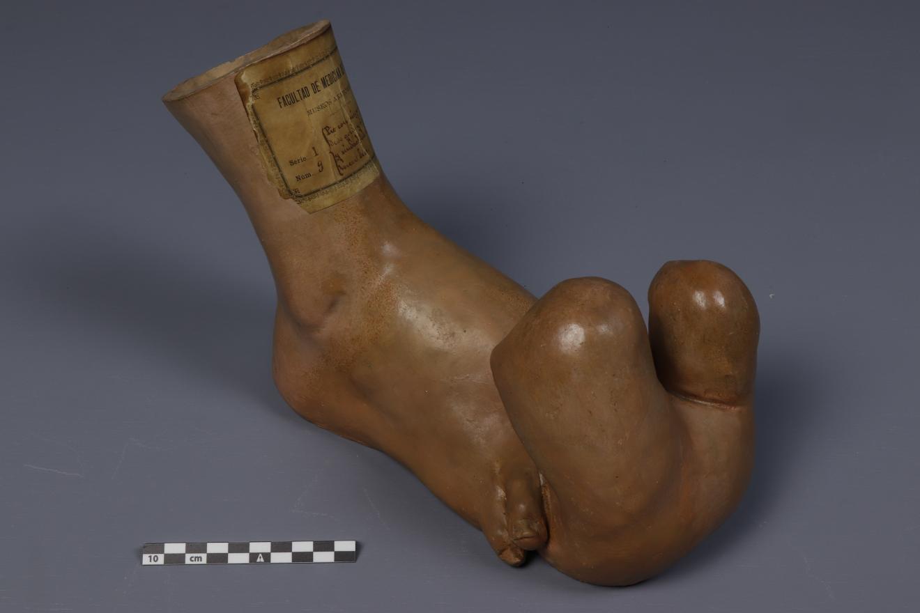 Megalodactilia del 1º y sindactilia del 2º y 3º