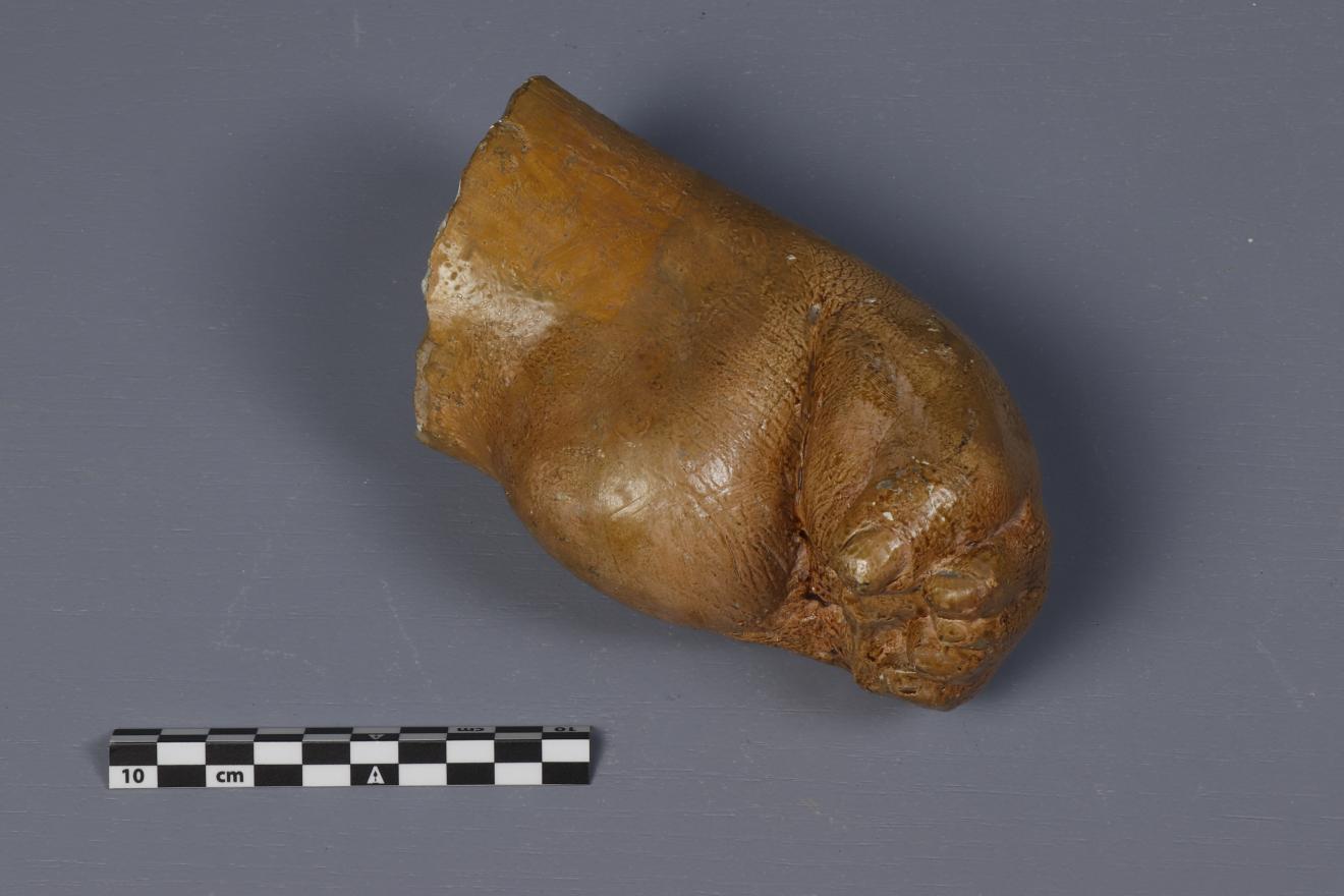 Pie con malformación